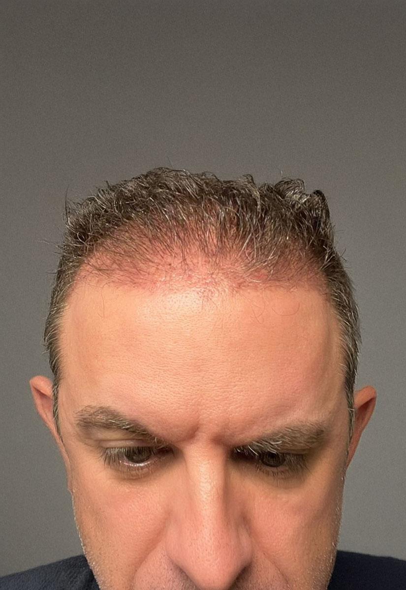 pelo-comparativa-01-A