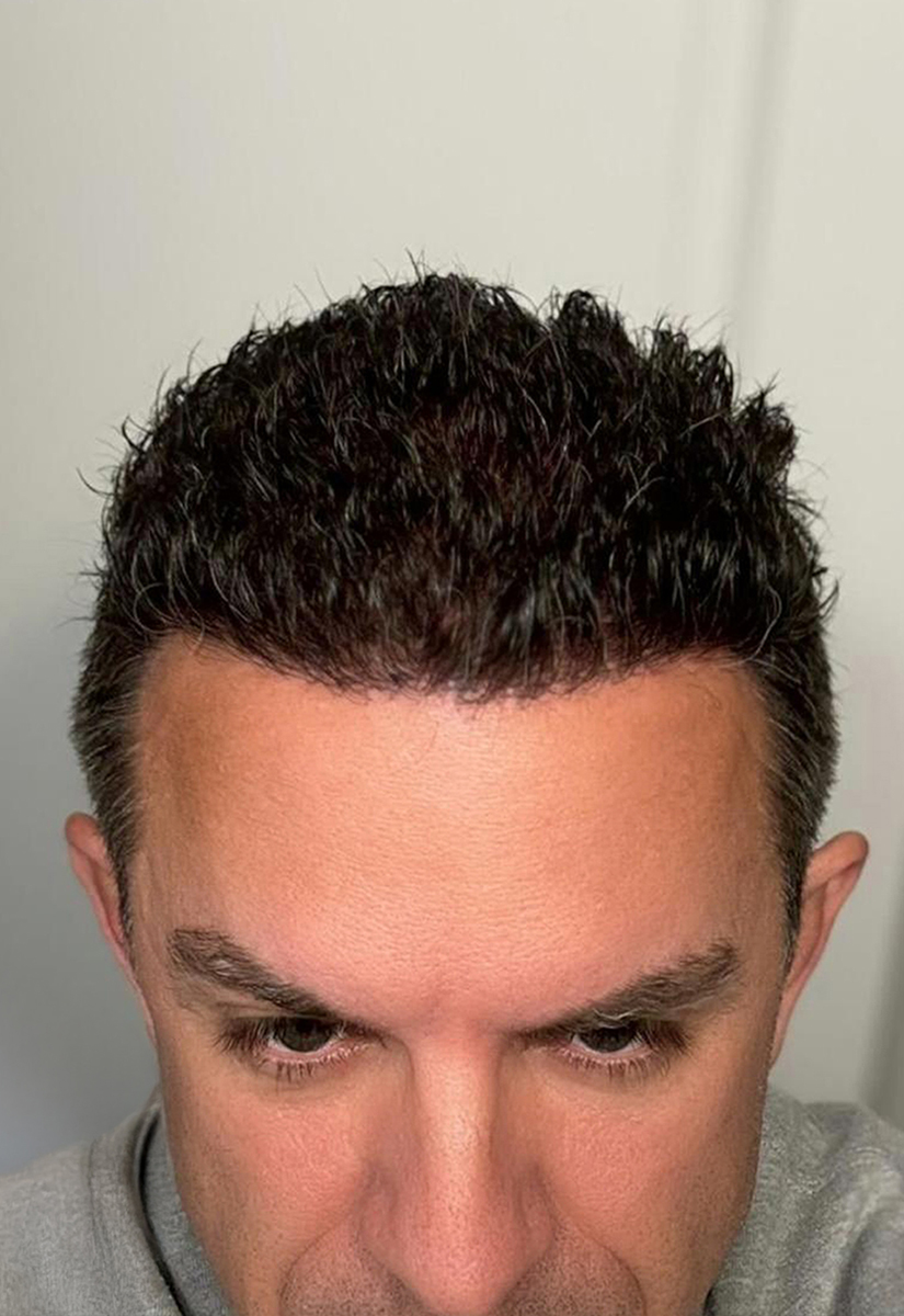 pelo-comparativa-01-B