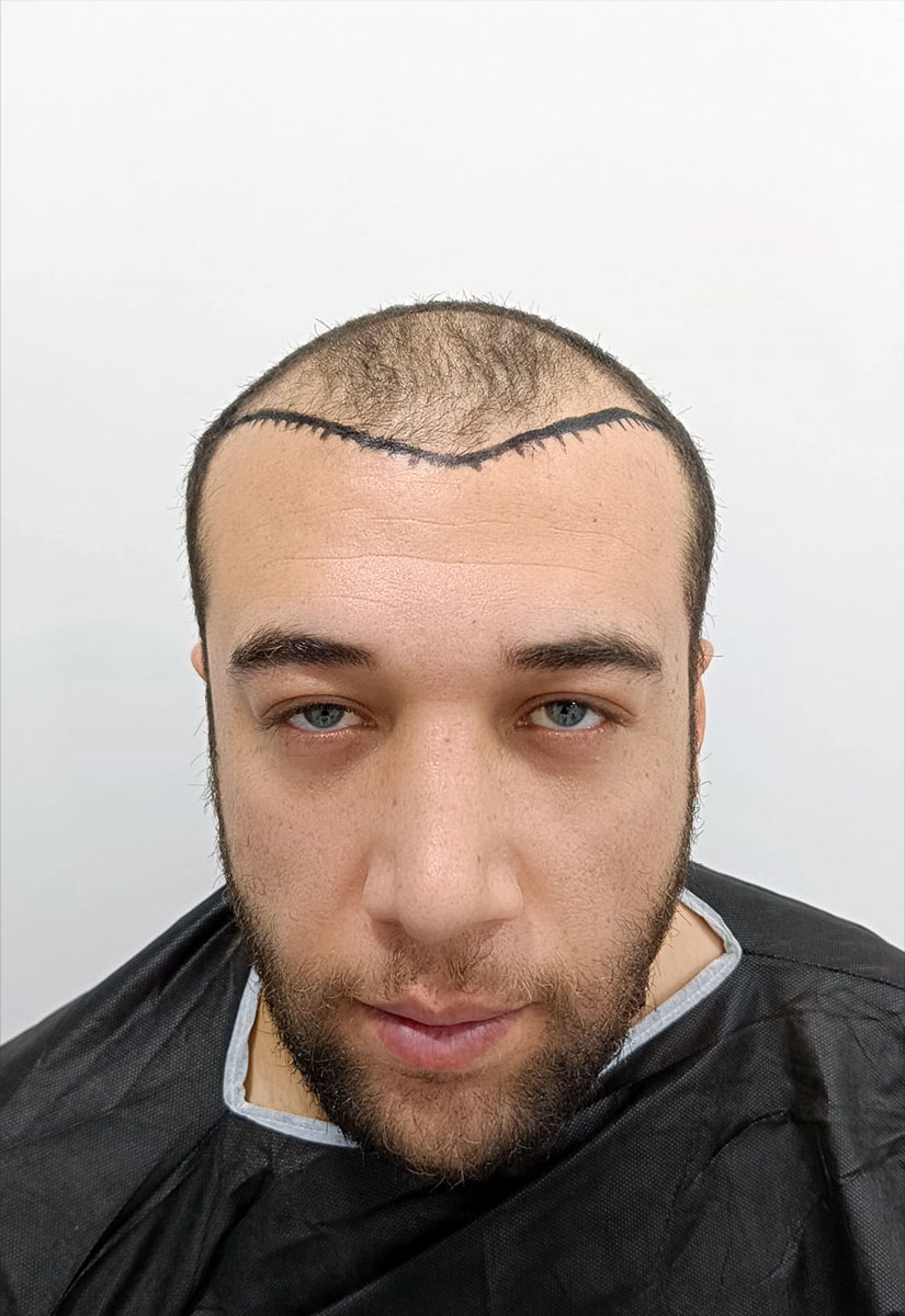 pelo-comparativa-02-A