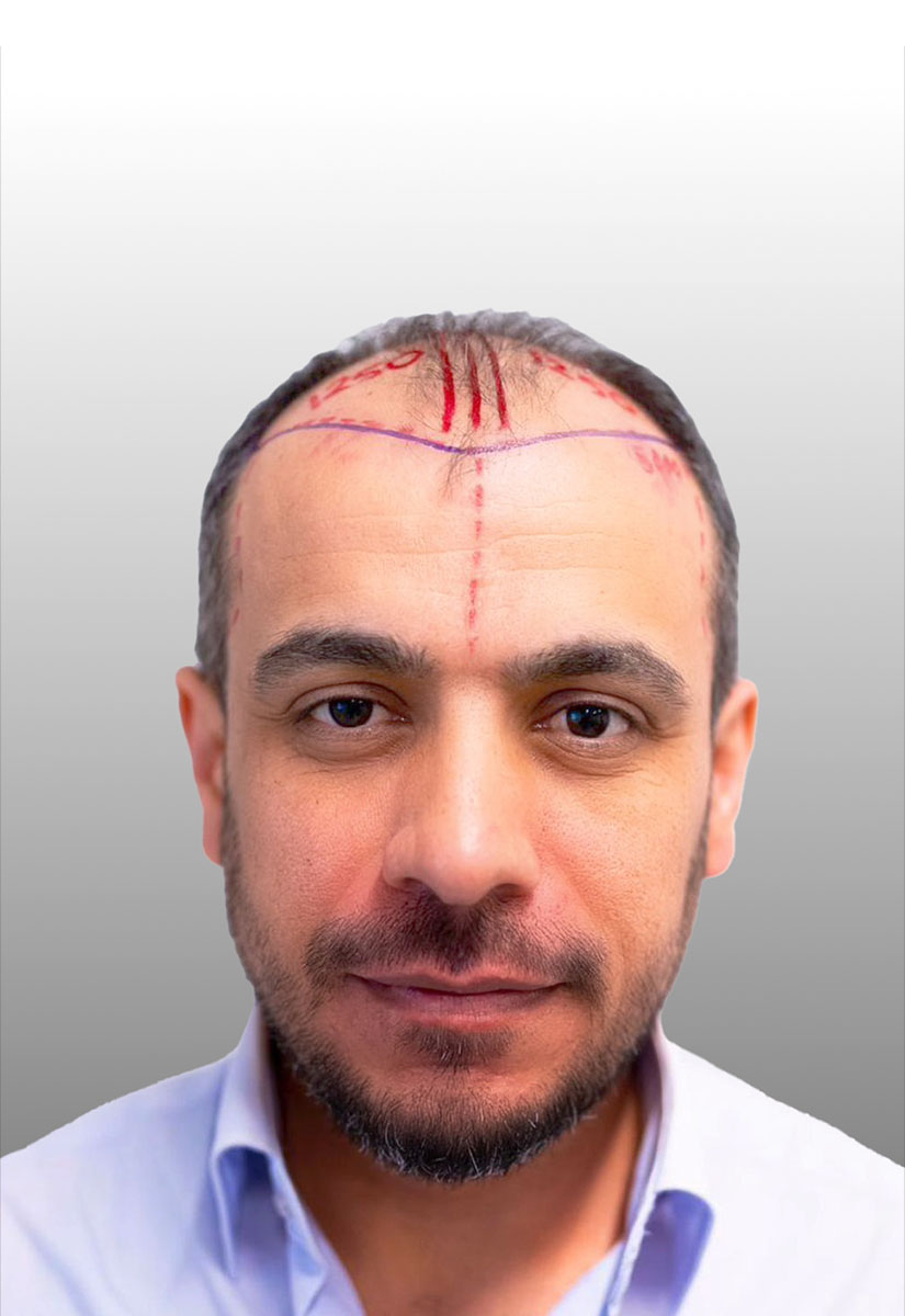 pelo-comparativa-03-A